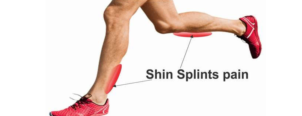 Physio for shin splints